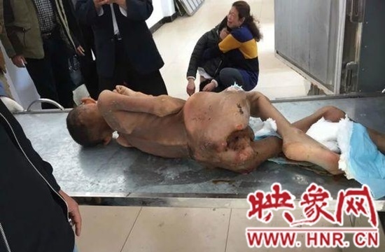 河南一男童走失半年 再见成"干尸"