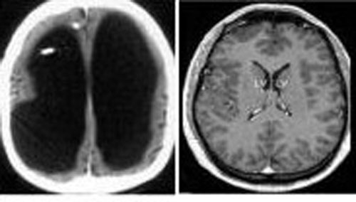 “无脑人”生活很正常_新闻中心_新浪网
