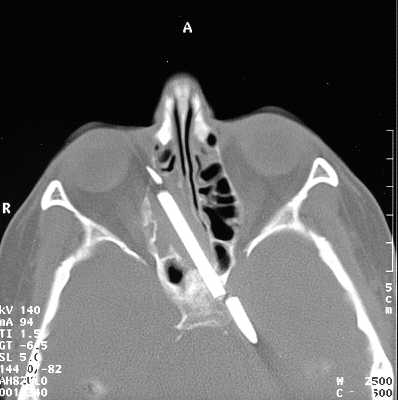6厘米铅笔从大脑里取出来了