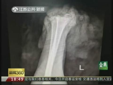 医院经过十个小时的抢救,小王左手的血管、神经、关节被接上 医院经过十个小时的抢救,小王左手的血管、神经、关节被接上
