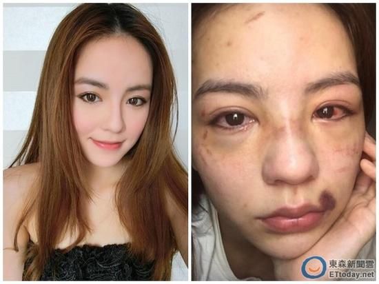 嫩版徐若瑄被打成猪头