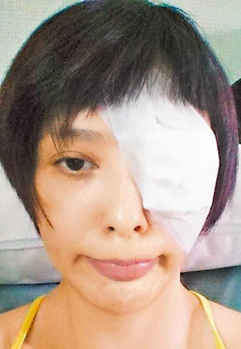 萧淑慎左眼眼球表面撕裂