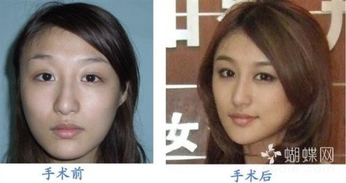 刘羽琦手术前后 刘羽琦手术前后