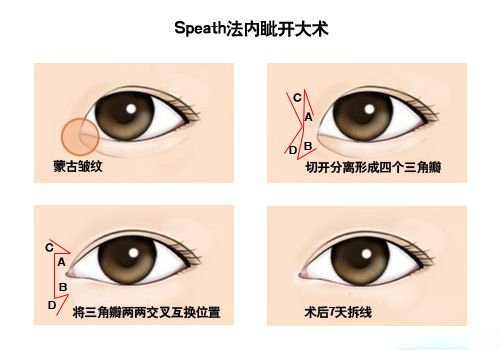 Speath法内眦开大术