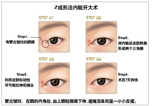 Z成形法内眦开大术