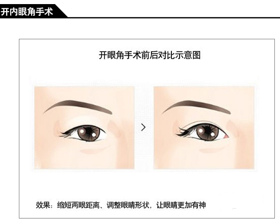 开内眼角手术