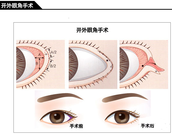 开外眼角手术