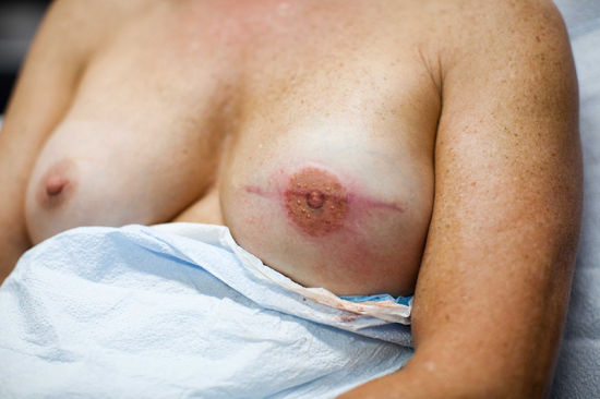 为乳腺癌康复者绘制纹身 为乳腺癌康复者绘制纹身
