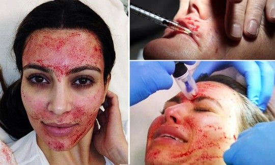 金-卡戴珊示范人血美容