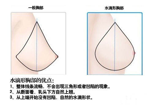 韩式隆胸新概念 水滴型胸部受追捧 韩式隆胸新概念 水滴型胸部受追捧