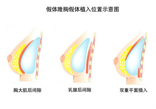 韩式隆胸新概念 水滴型胸部受追捧 韩式隆胸新概念 水滴型胸部受追捧