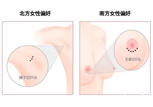 韩式隆胸新概念 水滴型胸部受追捧 韩式隆胸新概念 水滴型胸部受追捧