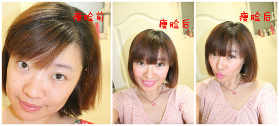 瘦脸前和瘦脸后大对比 瘦脸前和瘦脸后大对比