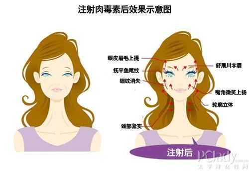 瘦腿瘦脸篇——肉毒杆菌