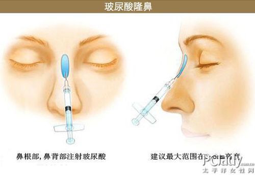 塑形篇——玻尿酸