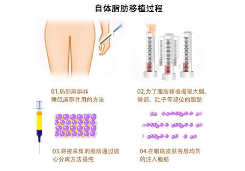 自体脂肪移植过程 自体脂肪移植过程
