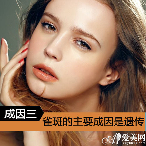 雀斑的主要成因是遗传