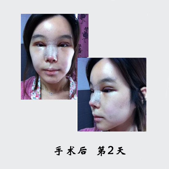 手术后第二天 手术后第二天