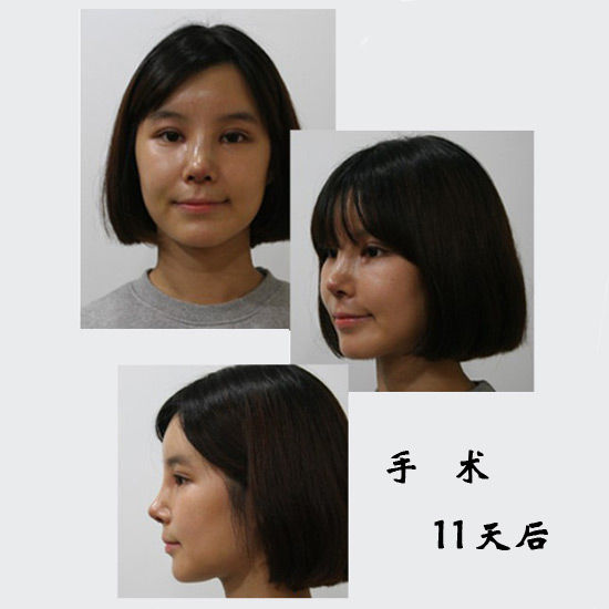 手术11天后 手术11天后