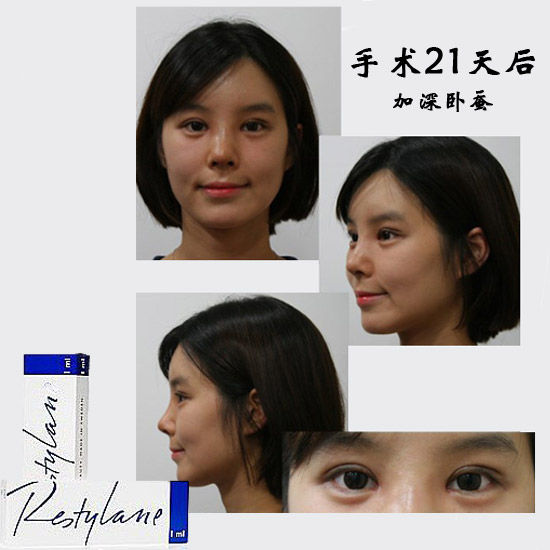 手术第21天后 手术第21天后