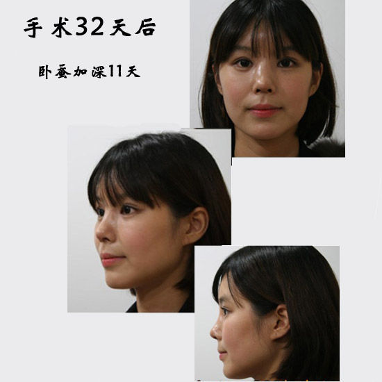 手术32天后 手术32天后