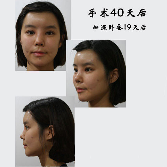 手术40天后照片 手术40天后照片