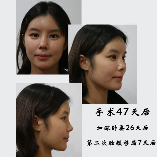 手术47天后 手术47天后