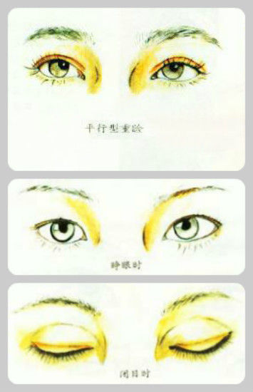 平行双眼皮 平行双眼皮
