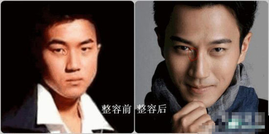 开眼角 开眼角双眼皮