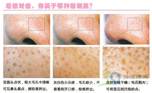 83.8%的人挤粉刺疤痕