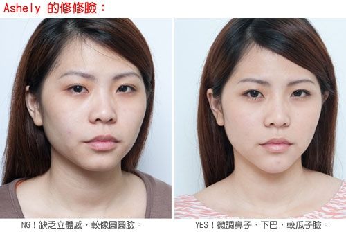 用玻尿酸进行面部轮廓塑形后,效果还是很明显的。 用玻尿酸进行面部轮廓塑形后,效果还是很明显的。