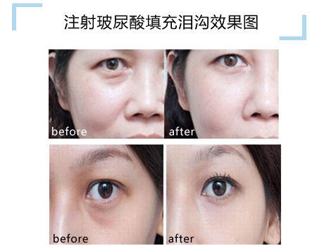 玻尿酸填充泪沟前后对比图。 玻尿酸填充泪沟前后对比图。