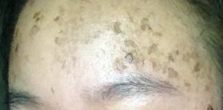 正在蜕皮中的额头 正在蜕皮中的额头