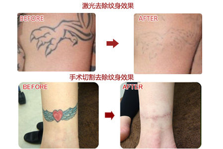 洗纹身效果图 洗纹身效果图