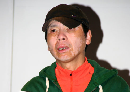 冯小刚:牙齿不规则还有白癜风 冯小刚:牙齿不规则还有白癜风