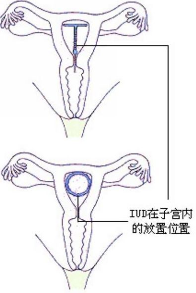 宫内节育器原理 宫内节育器原理