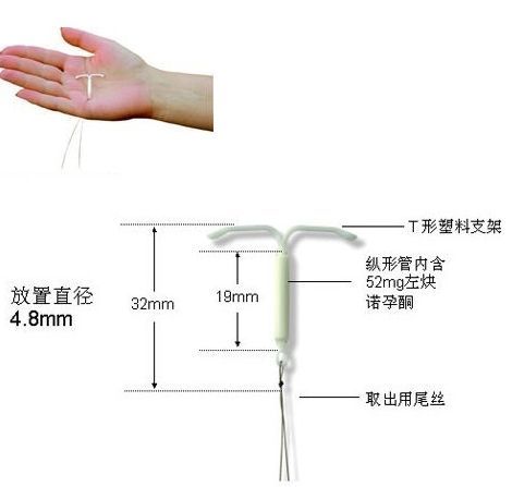 现在广泛使用的“T”型节育器 现在广泛使用的“T”型节育器