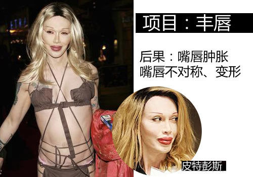 皮特彭斯,丰唇失败变“腊肠”嘴。 皮特彭斯,丰唇失败变“腊肠”嘴。