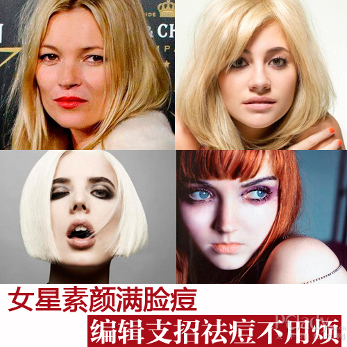 女星素颜满脸痘 编辑支招祛痘不用烦凯特-摩丝素颜