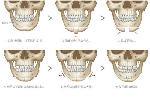 四方脸变v脸:韩式v-line脸型重塑   很多人羡慕韩国mm的精致小脸