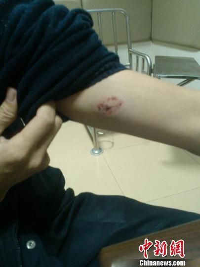 民警左手臂在劝阻过程中被醉酒男子咬伤，齿痕清晰可见，周围有瘀血。 警方提供 摄