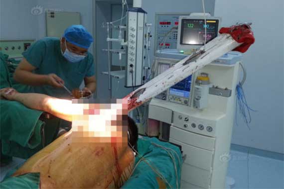 河南一司机撞断护栏 致使栏杆穿胸而过