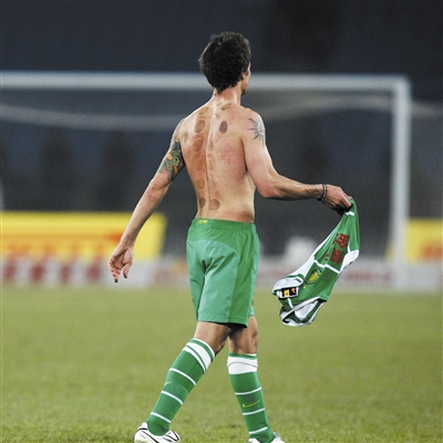 乔尔拔火罐的痕迹清晰可见 乔尔拔火罐的痕迹清晰可见