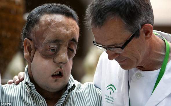 拉法尔术后称可以从镜子中认出自己。他是西班牙第二个、世界上第九个接受局部面部移植手术的人