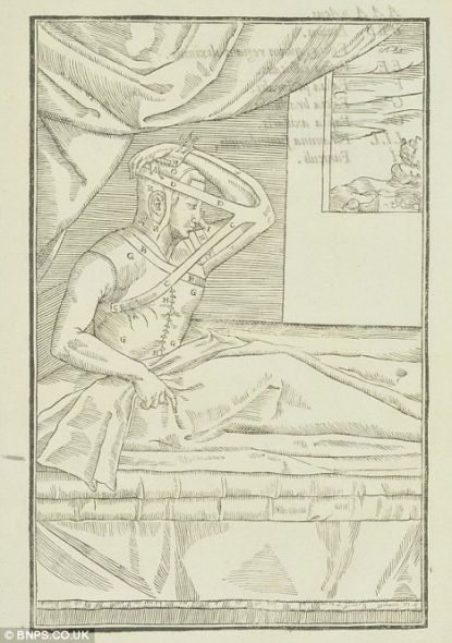 这是世界上首个鼻部整形手术插图，患者的鼻部皮肤与上臂皮肤连接在一起