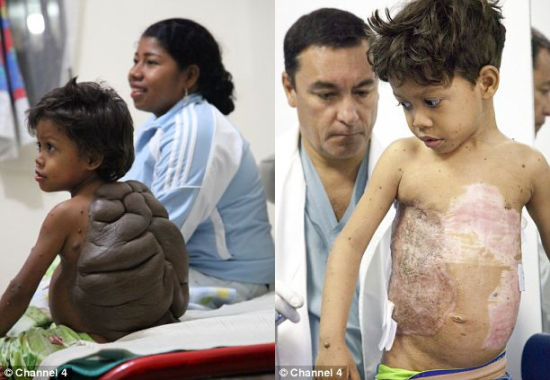 　　哥伦比亚男孩迪迪尔-蒙塔沃，背上长着巨大胎痣。在英国整形外科医生尼尔-布尔斯拖德的帮助下，可怕的胎痣已经切除