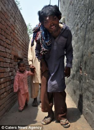 普罗特斯综合症又名“变形综合症”，导致患者的确定部位严重发育过度。