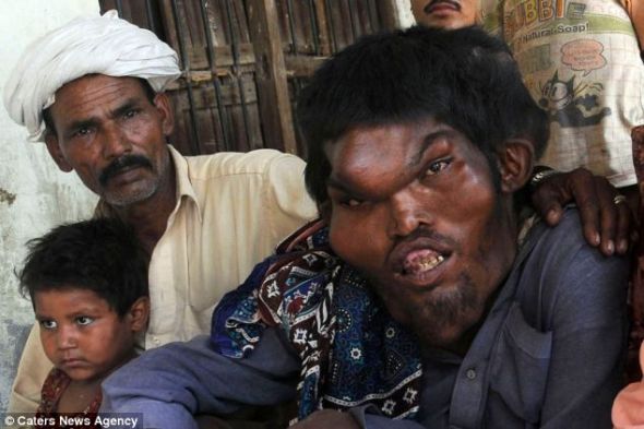 　　穆塔兹希望将来能够把病治好，而后找一个爱他的女孩。最初，当地人对他非常害怕，现在已经接受了他的样貌