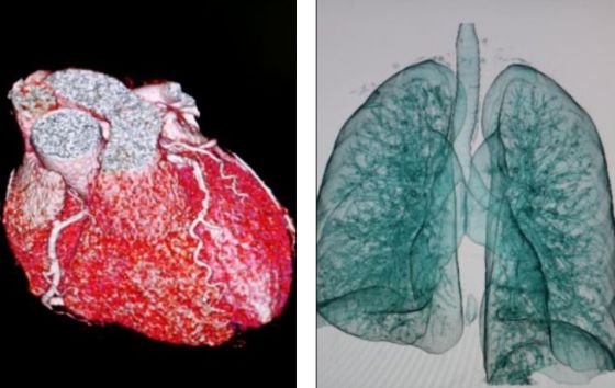 世界上速度最快的CT扫描仪拍摄的心脏和肺部图像