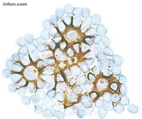 树突状细胞（褐色）将抗原递呈给淋巴细胞（蓝色）产生“免疫应答”，这也是DC疫苗治疗癌症的原理